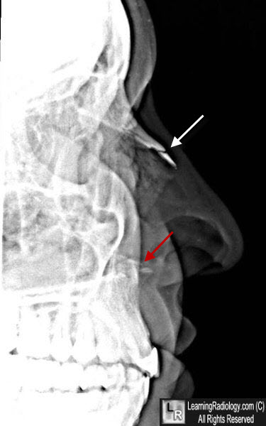 nasal bone fracture